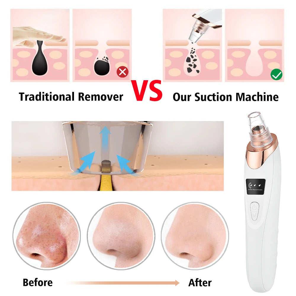 Dermaclean™ — Deep Pore Extractor with 3 Suction Levels